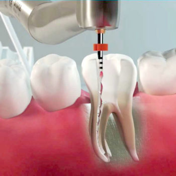 Endodonzia Dentale